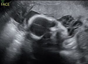 Manhattan-Kansas-tubal-reversal